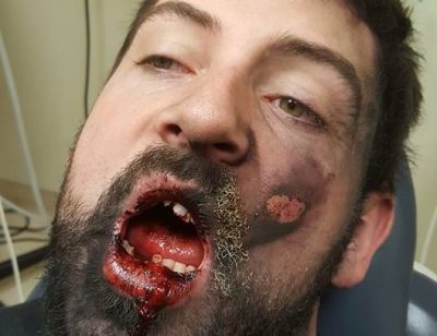Житель США лишился семи зубов из-за взорвавшейся электронной сигареты