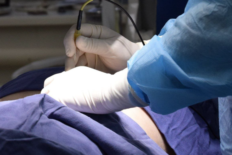 В Кемерове врачи через один прокол спасли пациенту почку