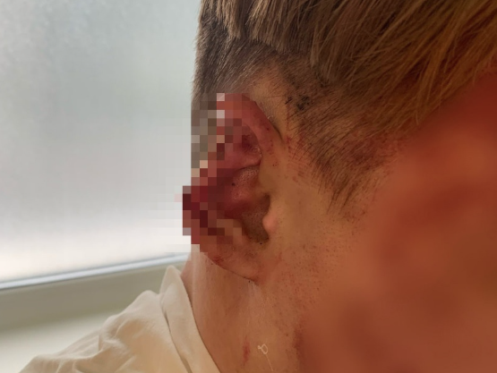 Соцсети: агрессивные людоеды откусили нос и ухо парням в Кузбассе (фото 18 +)